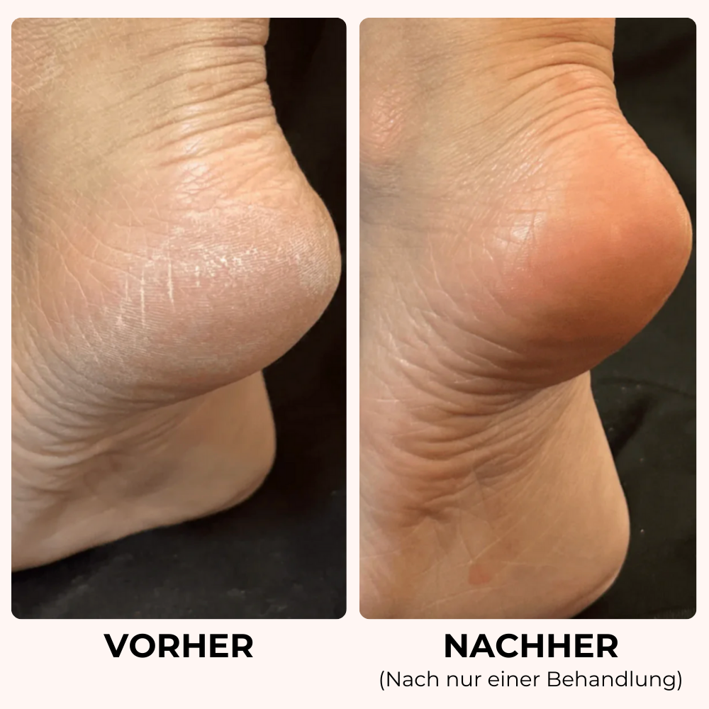 GlowFeet™ - glatte Füße in wenigen Minuten!